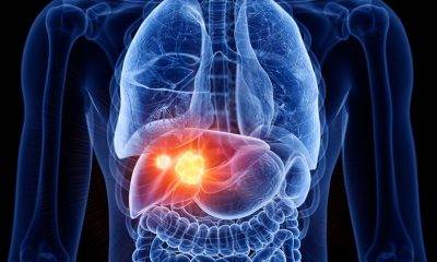 Liver Cancer Where We Are 1