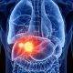 Liver Cancer Where We Are 1